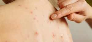 Measles spreads in 16 districts: Report