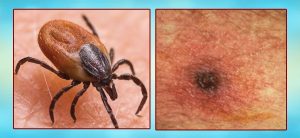 78 cases of scrub typhus diagnosed since July